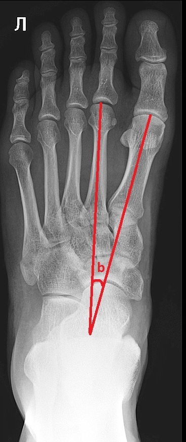 Foot pathology for everyone - Traumatology, The medicine, Feet, Longpost