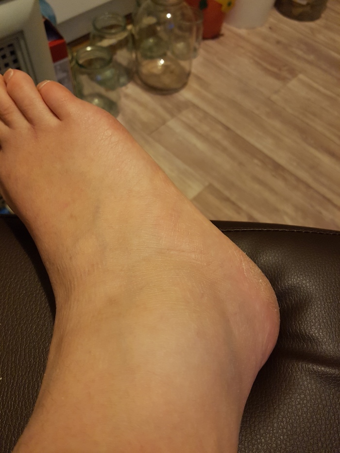 #перелом #ушиб