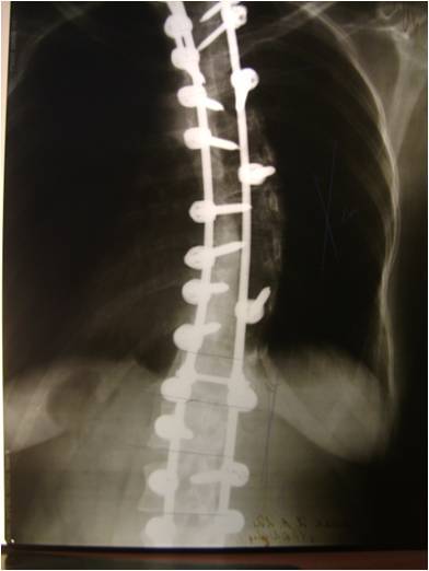 Scoliosis. Enlightenment fast - My, Scoliosis, Curvature of the spine, Kyphosis, Longpost