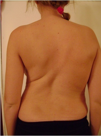 Scoliosis. Enlightenment fast - My, Scoliosis, Curvature of the spine, Kyphosis, Longpost