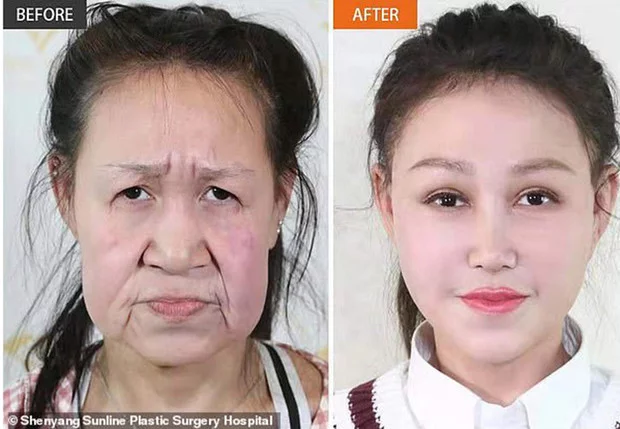 I want to know everything #584. A Chinese girl looked like an old woman at the age of 15 due to a rare disease, but plastic surgery fixed everything - Want to know everything, China, Girl, Disease, Progeria, Plastic surgery, Face, Longpost
