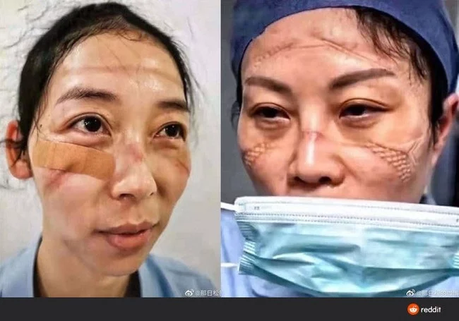 Nurse in Wuhan after shift change - Coronavirus, Wuhan, China, Mask, Reddit