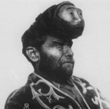 Pascual Pinon with his second head - Tumor, Circus, Mexicans