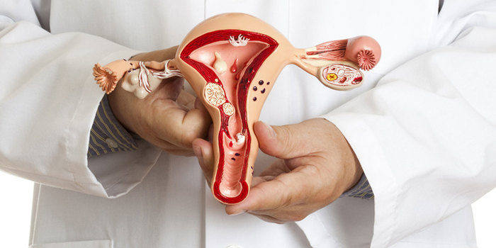 Are uterine fibroids dangerous? - uterine fibroids, Gynecology, Tumor, Women, Health, The medicine, Longpost