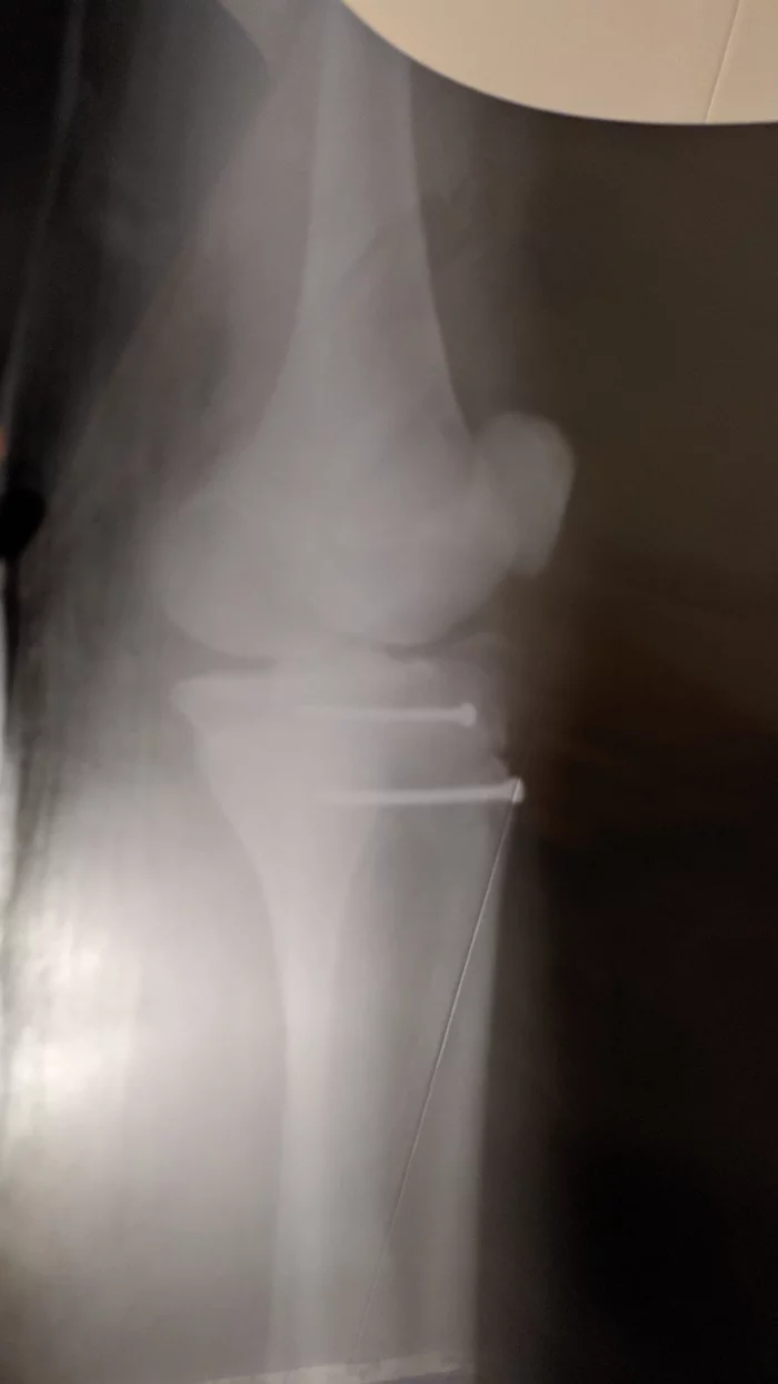 Broken leg, my story. For my birthday - My, Broken leg, Story, Longpost