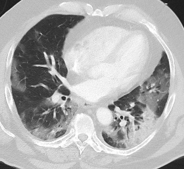 Chest Exams - March 2020 - My, Coronavirus, Pandemic, The medicine, X-ray, CT