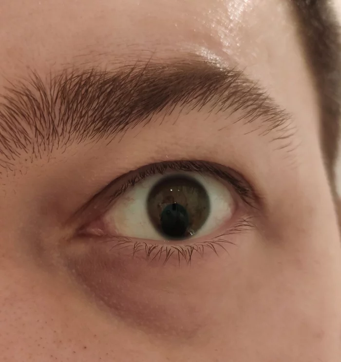 Is it possible to get rid of coloboma? - My, coloboma, Oculist, Doctors, The medicine, Longpost, Eyes, Vision, Question