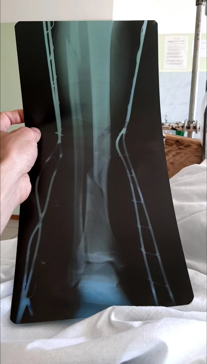 Double fracture. Operation Part 1 - My, Broken leg, Hospital, Traumatology, Operation, The photo, The medicine, Mat, Longpost