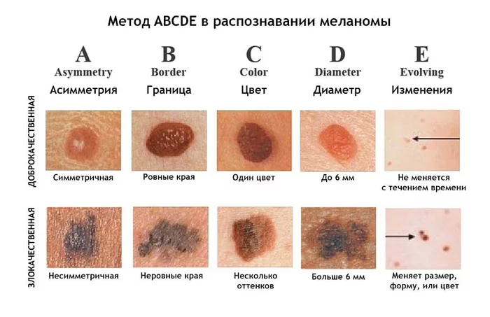 Healthy brain об онкологии - Моё, Здоровье, Медицина, Рак и онкология, Меланома, Солнце, Лето