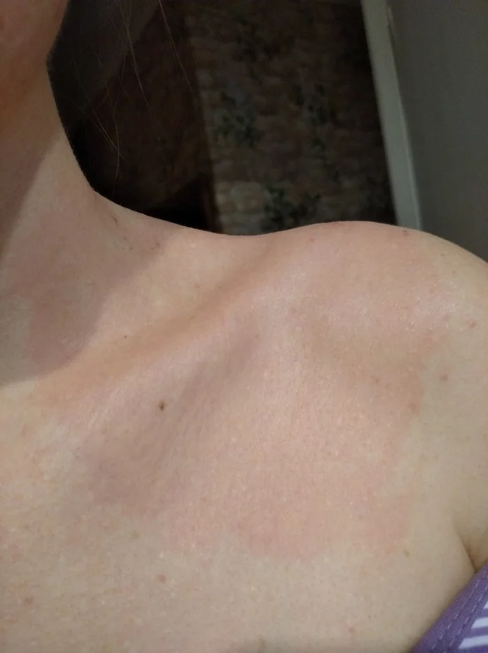 Red spot on the body - My, Spot, red spot, Allergy, Burn, What's this?, Longpost