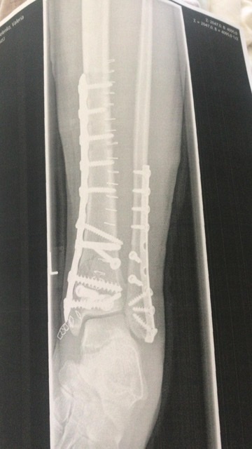 История моего первого перелома - Моё, Перелом ноги, Операция, Длиннопост, Аппарат илизарова