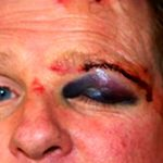 What to do if you/child/friend has a minor facial injury - Crash, Bike ride, Accident, Real life story