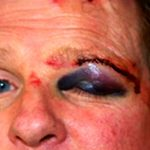 What to do if you/a child/friend has a minor facial injury - Crash, Bike ride, Accident, Real life story