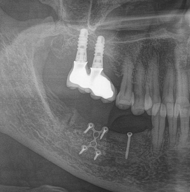 Dentistry: expectation and reality - My, Dentist, Dentistry, Surgeon, Doctors, Teeth, Dental implantation, The medicine, Doctor, Longpost