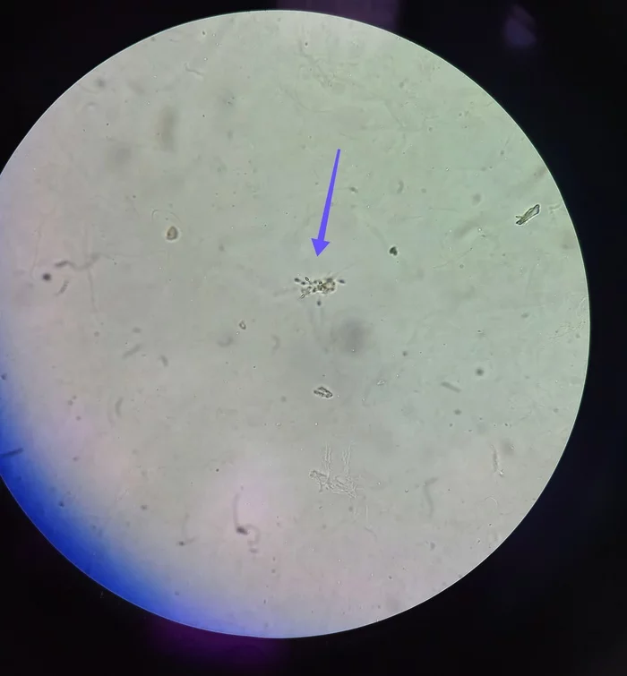 Spermatozoa in urine sediment - My, Kld, Microscopy, Microscope, Analysis, Laboratory, Urine, Sperm, The medicine