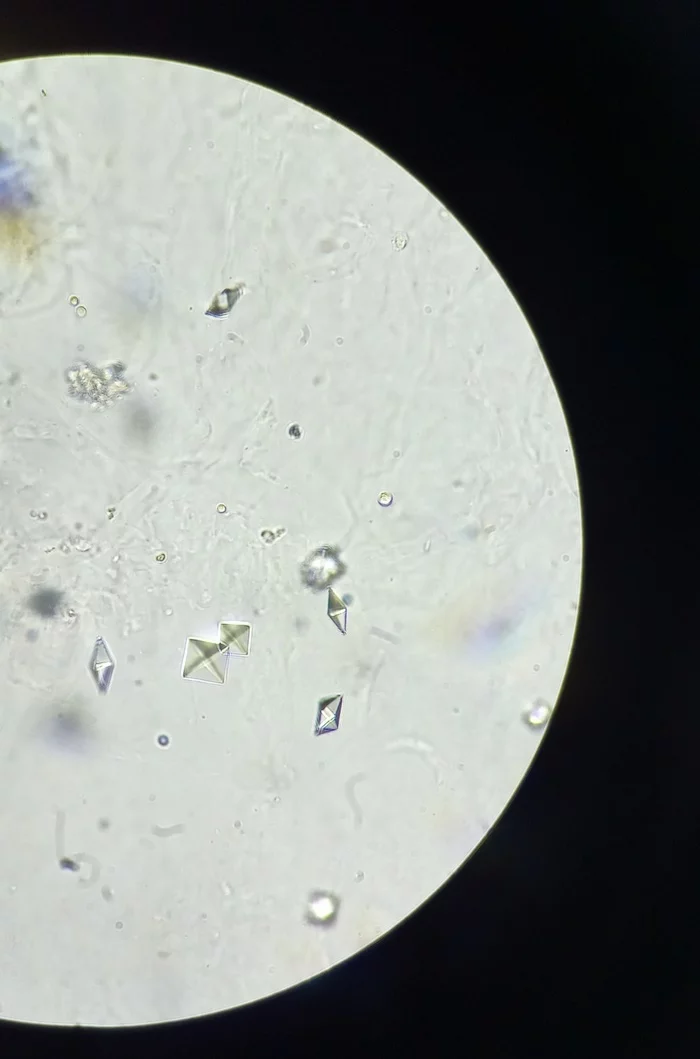 Calcium oxalate crystals in urine - My, Microscopy, Microscope, Laboratory, Analysis, The medicine, Kld, Crystals