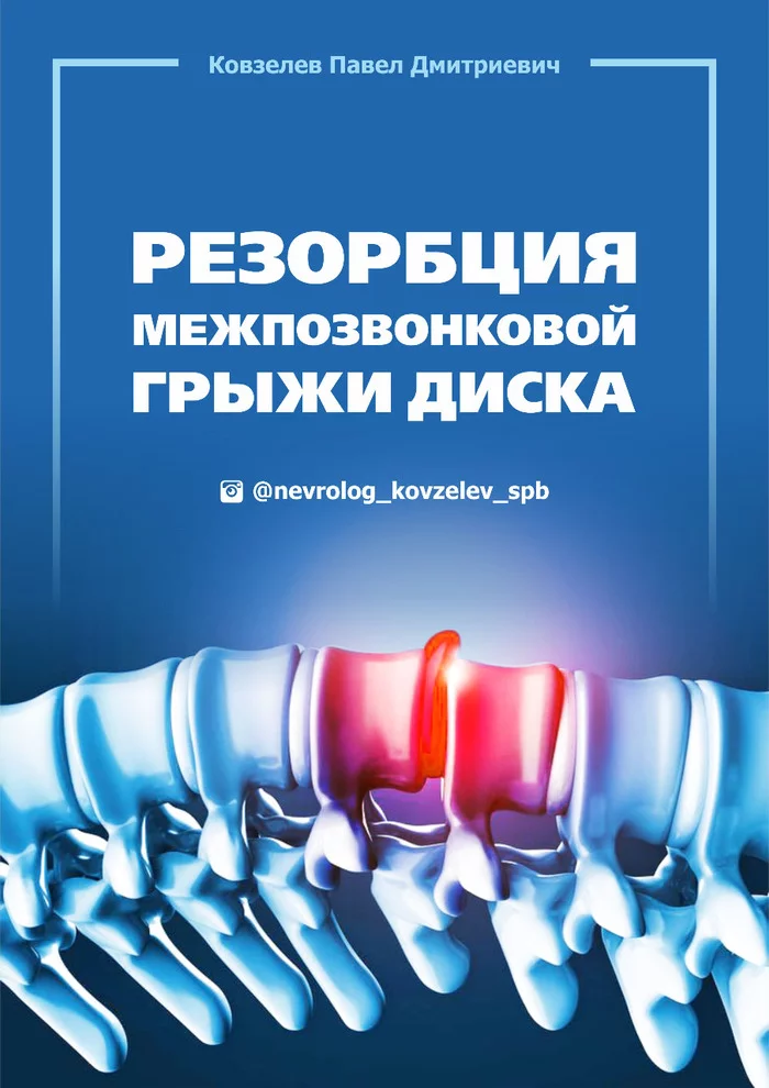 Резорбция грыжи диска. Руководство для пациентов - Моё, Медицина, Неврология, Грыжа, Межпозвоночная грыжа, Спина, Гайд, Длиннопост