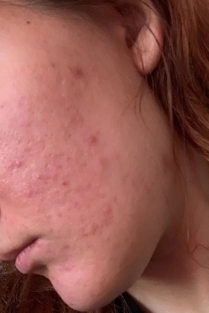 Roaccutane and my story about new skin - My, Roaccutane, Acne, Problem skin, Acne, Longpost