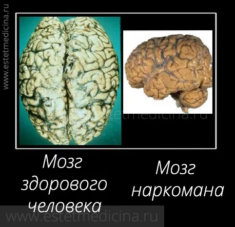 мозги после употребления наркотиков