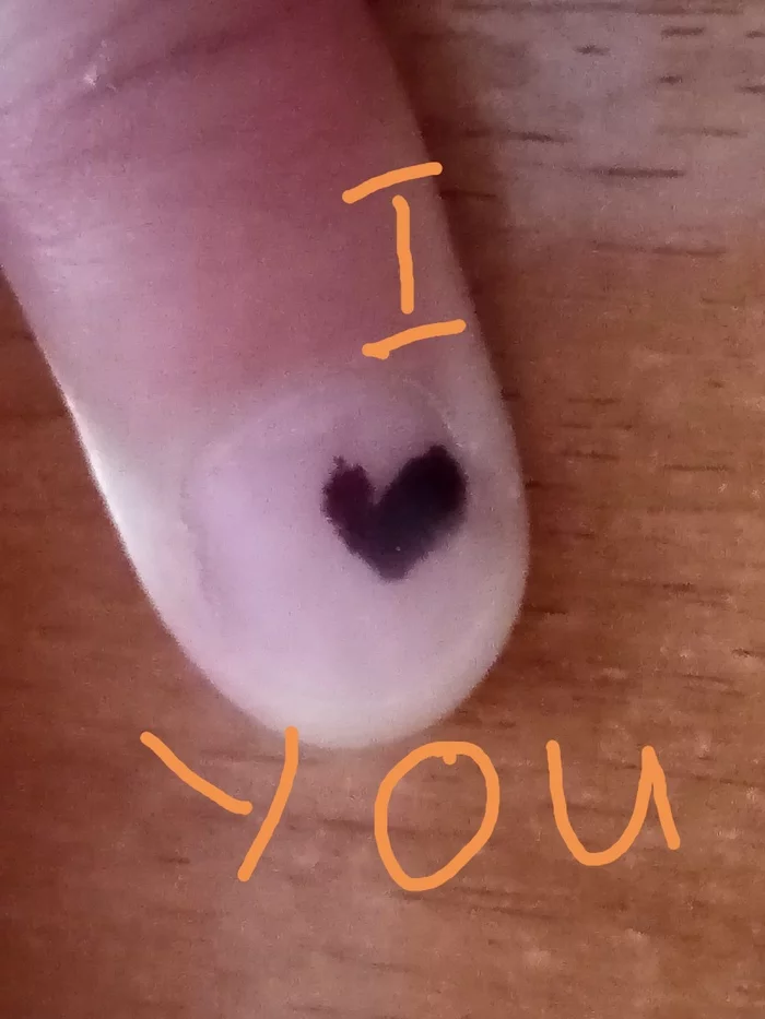 My little finger. And the standard Photoshop of the phone) - My, Little finger, Bruise, Pinched, Love