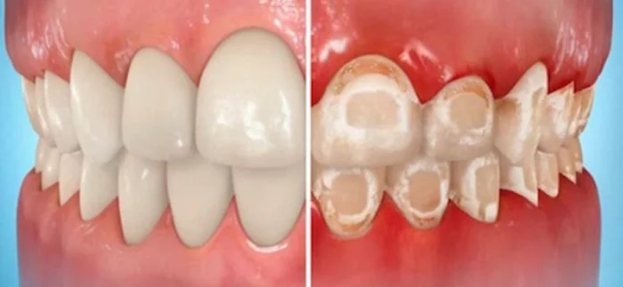 Do braces ruin your teeth? - My, Braces, Dentistry, Orthodontics, Orthodontist, Longpost