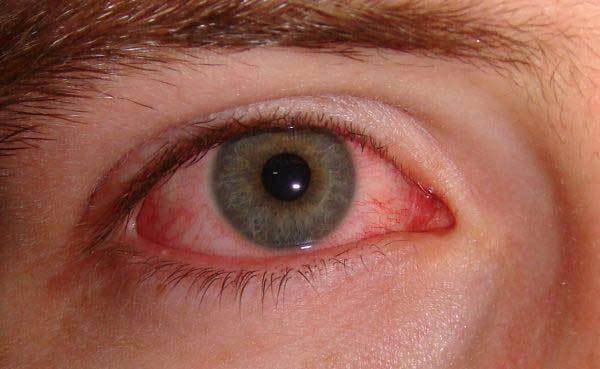 Химический ожог глаз: лечение в домашних условиях