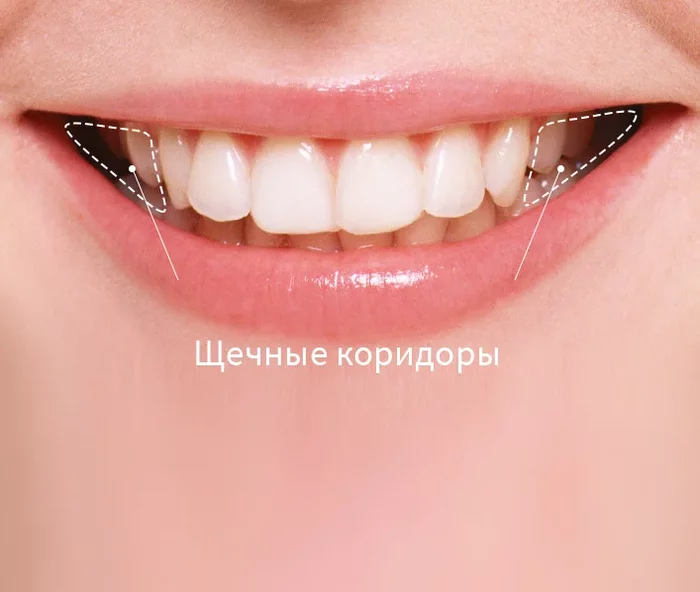 Smile aesthetics: #4 Smile width - My, Braces, Dentistry, Orthodontics, Orthopedics, Dentist, The medicine, Teeth, Health, Longpost