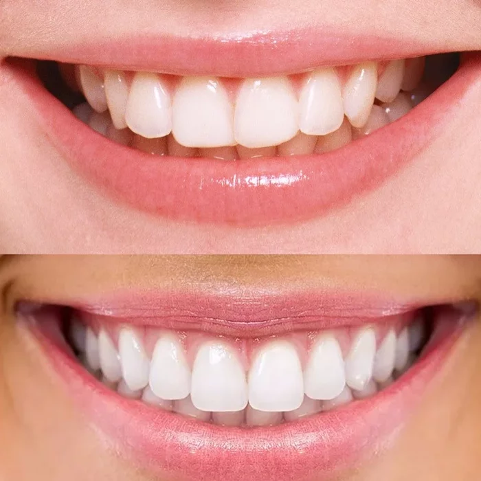 Smile 4. Зубы человека. Красивые правильные зубы. Круглые зубы.