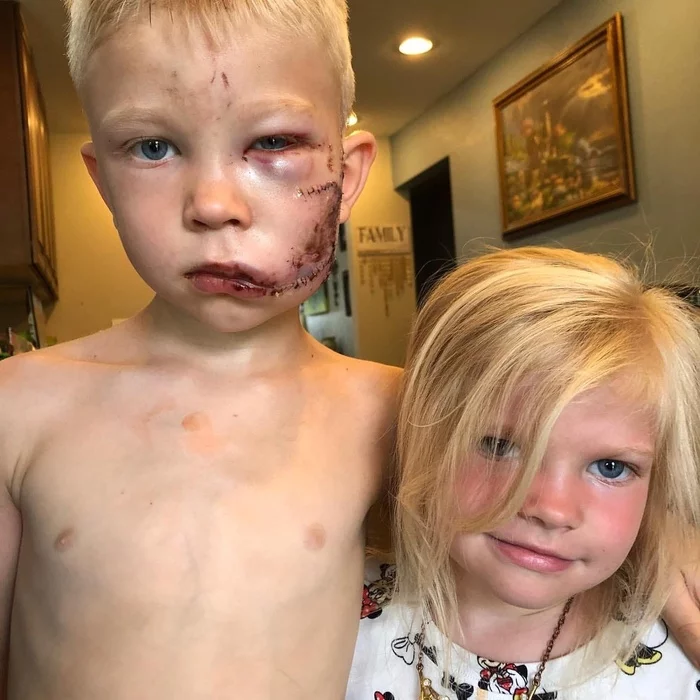 6-year-old brother saved his sister from a dog - Children, Heroes, Courage, Dog, news, Shock, People, Honor, Longpost