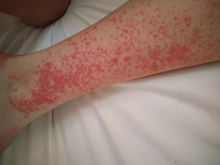 Help, strange rash - My, Rash, The medicine, Help, No rating