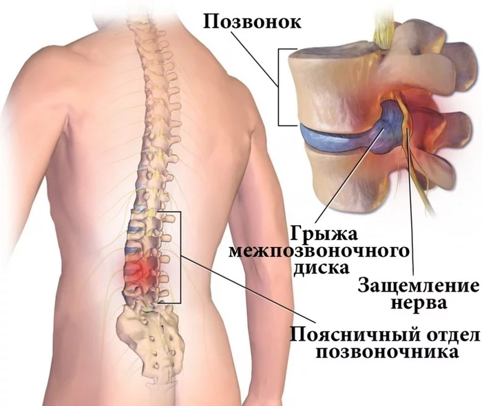 Through pain to a bright future - My, Intervertebral hernia, Share