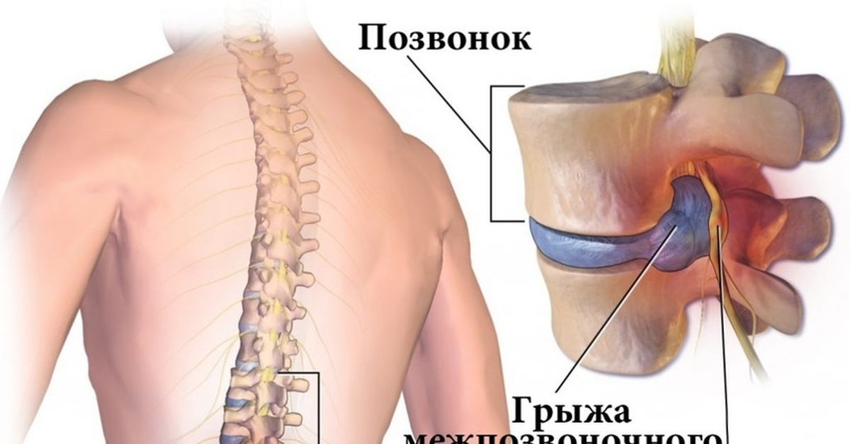 Цена операции на поясничную грыжу. Расположение позвонков l5-s1. Блокада межпозвоночной грыжи поясничного отдела. Блокада позвоночника при грыже.