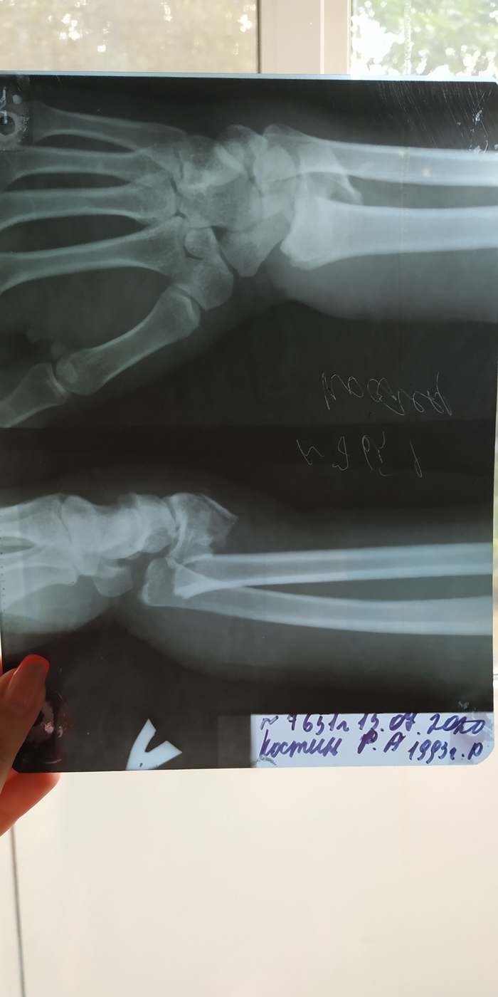 Рентгеновский снимок перелома руки