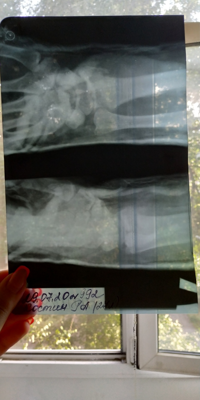 Перелом мизинца на ноге рентген фото