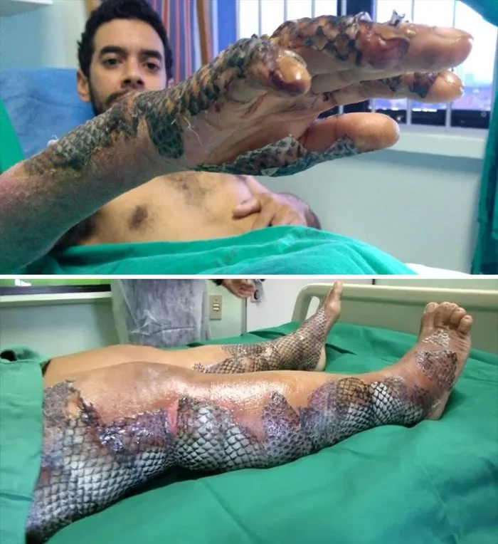 Hospitals in Brazil use bandages made from fish skin and scales to heal burns. - Brazil, Burn, A fish, Scales, Leather, Treatment
