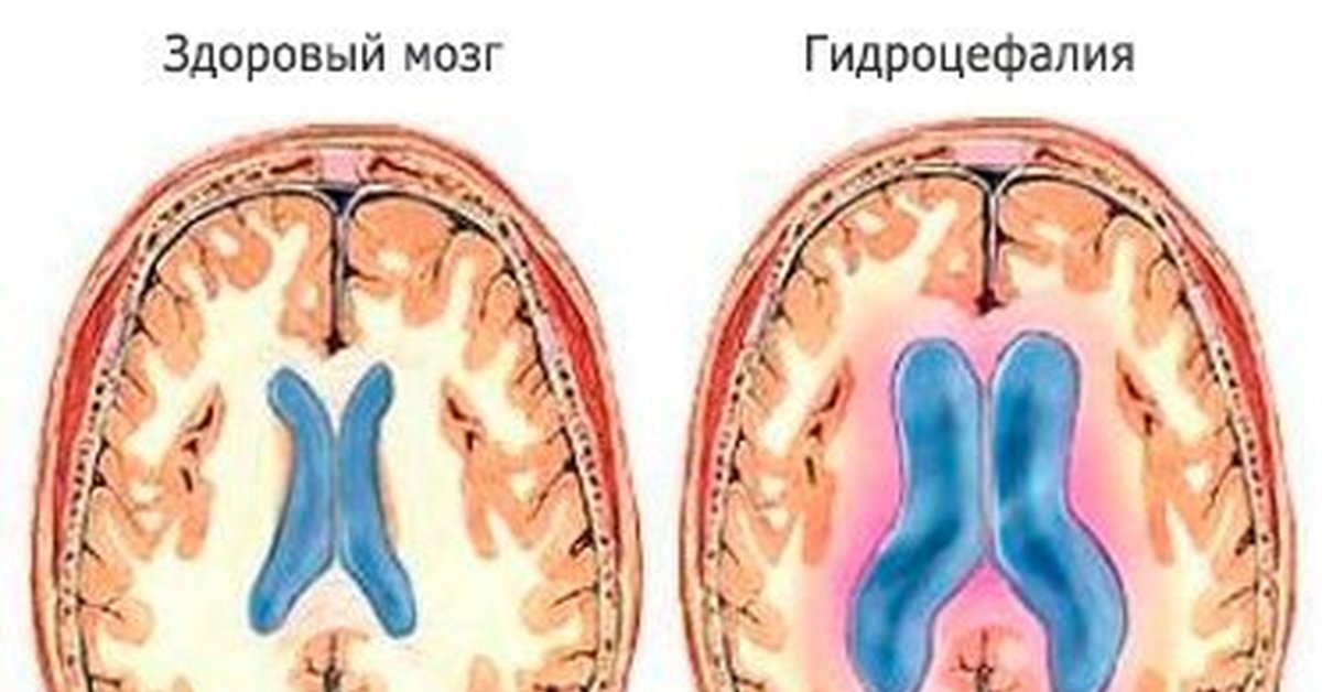 Водянка головного мозга у взрослого