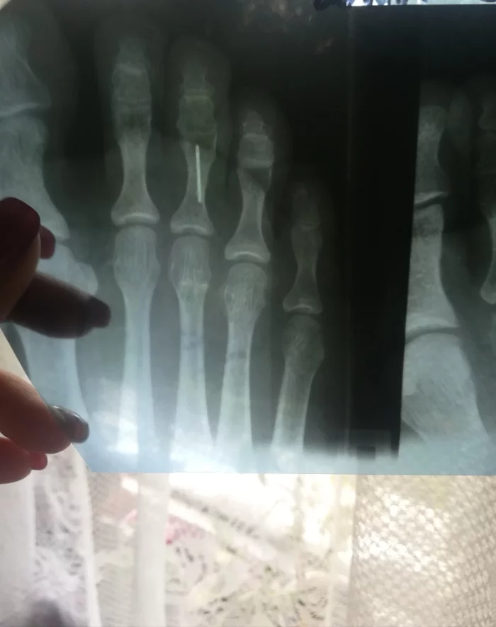 Maybe 2020 is to blame) - My, Life stories, Needle, Injury, X-ray