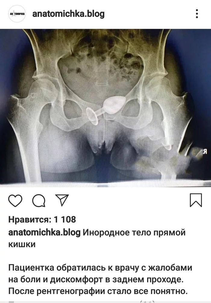 А говорили безопасно и не улетит - Рентген, Медицина, Анальная пробка, Instagram