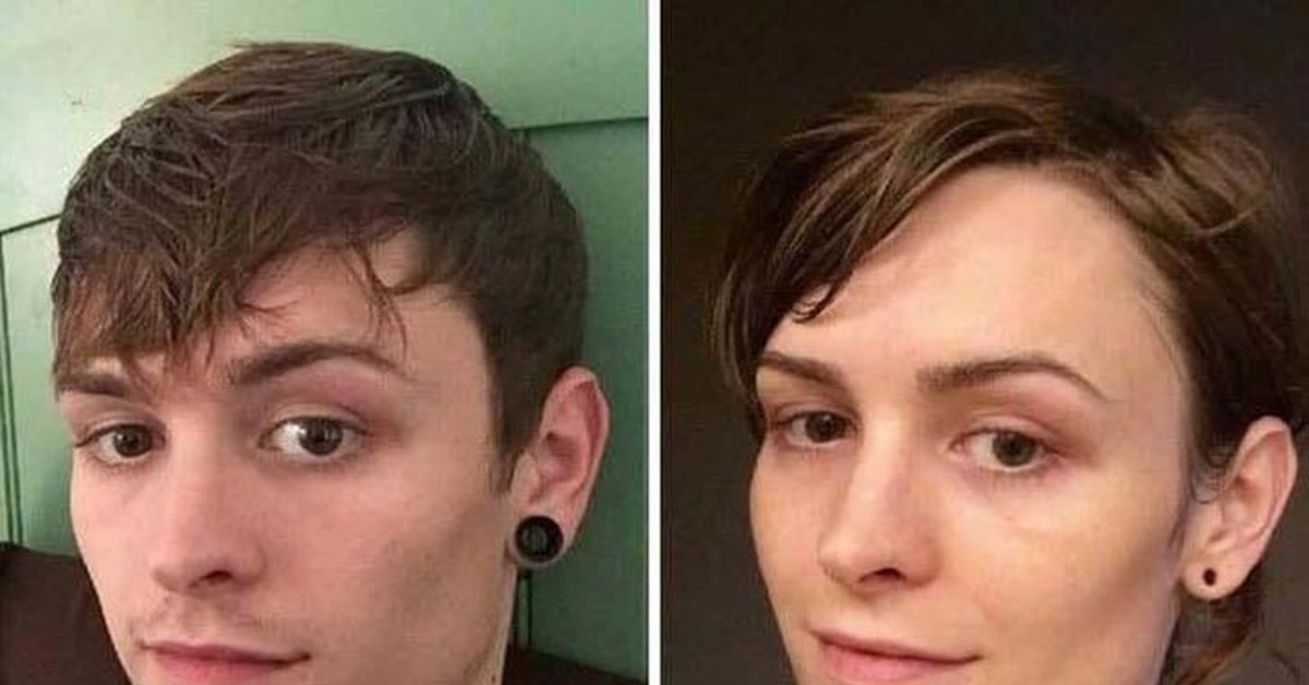 Два трансгендера. Опятьрация по смене пола. Из мужчины в женщину. Опирацыя по смена пола.