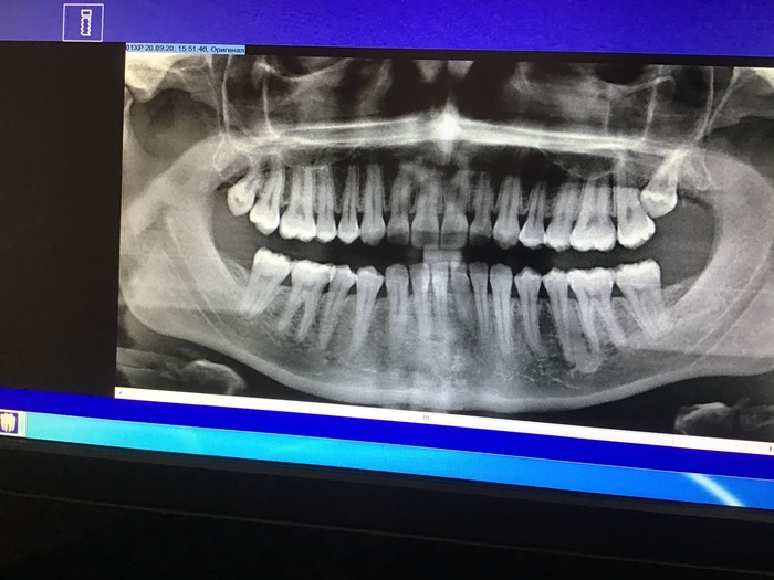 Проблемы с зубом мудрости