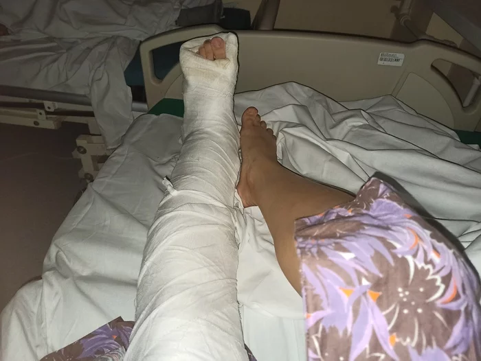 How to live with plaster? - My, Broken leg, What's next?, Longpost