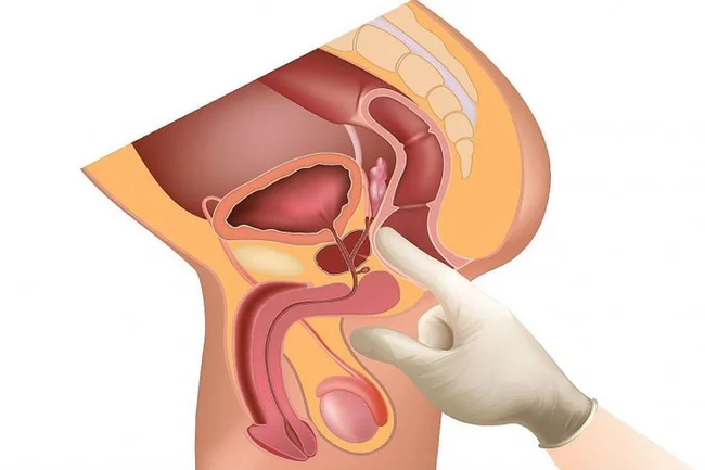 Digital rectal examination - Prostate, Urology, The medicine, Longpost