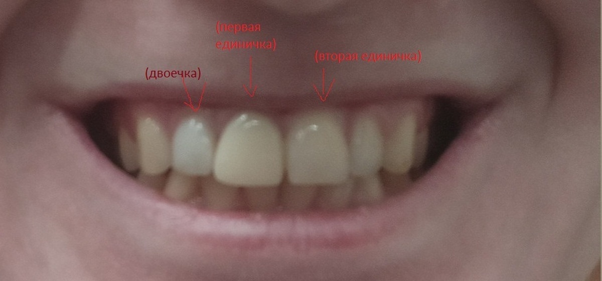 Чувствительны передние зубы