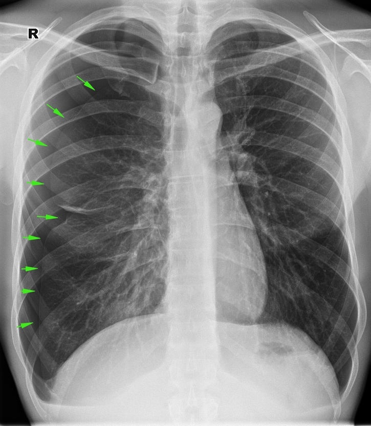 From the life of a radiologist. Part 16 - My, X-ray, The medicine, Fracture, Diverticulitis, Pneumothorax, Hydrothorax, Scoliosis, Longpost