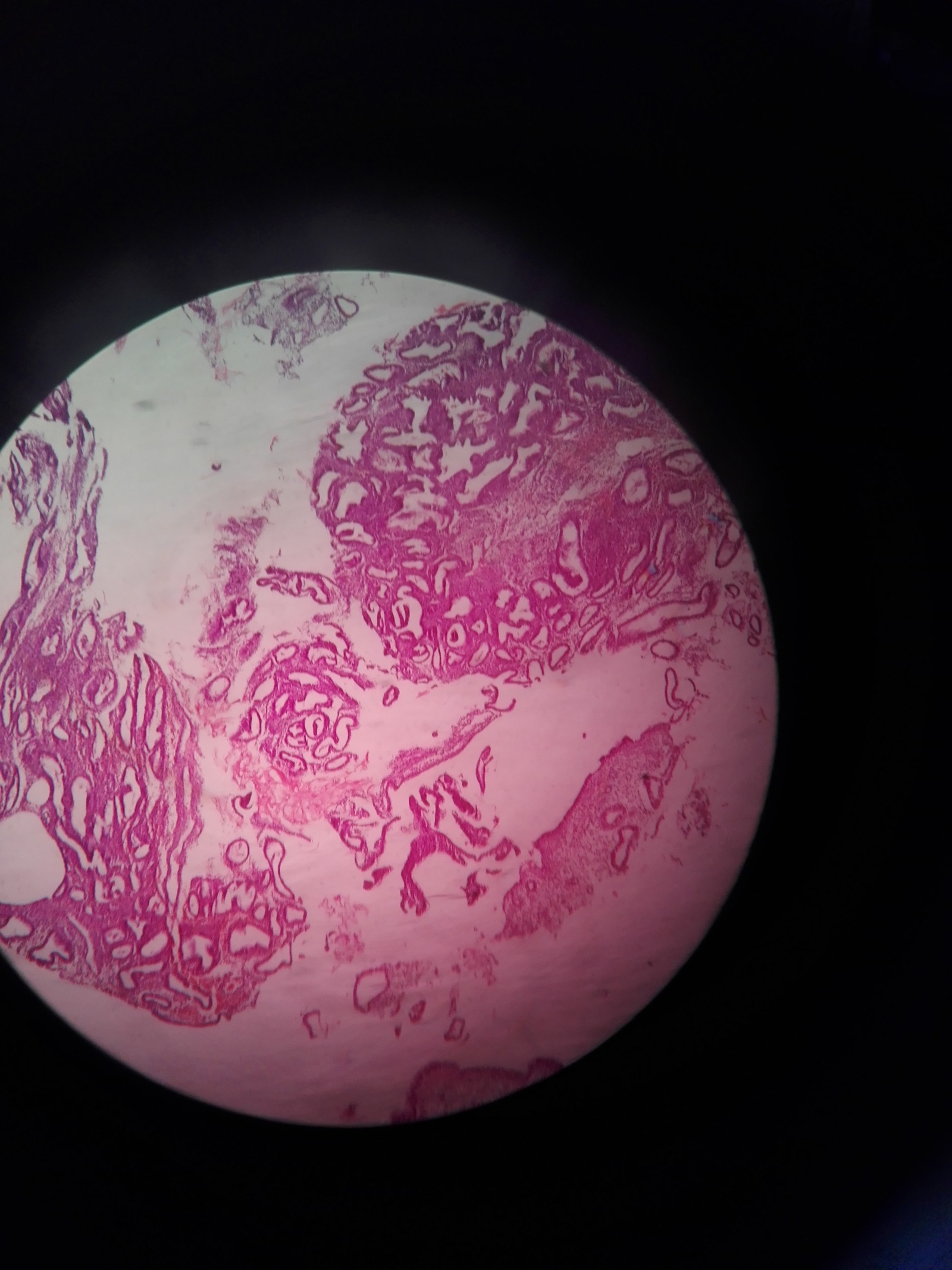 endometrium - My, The medicine, Oncology, Pathologist