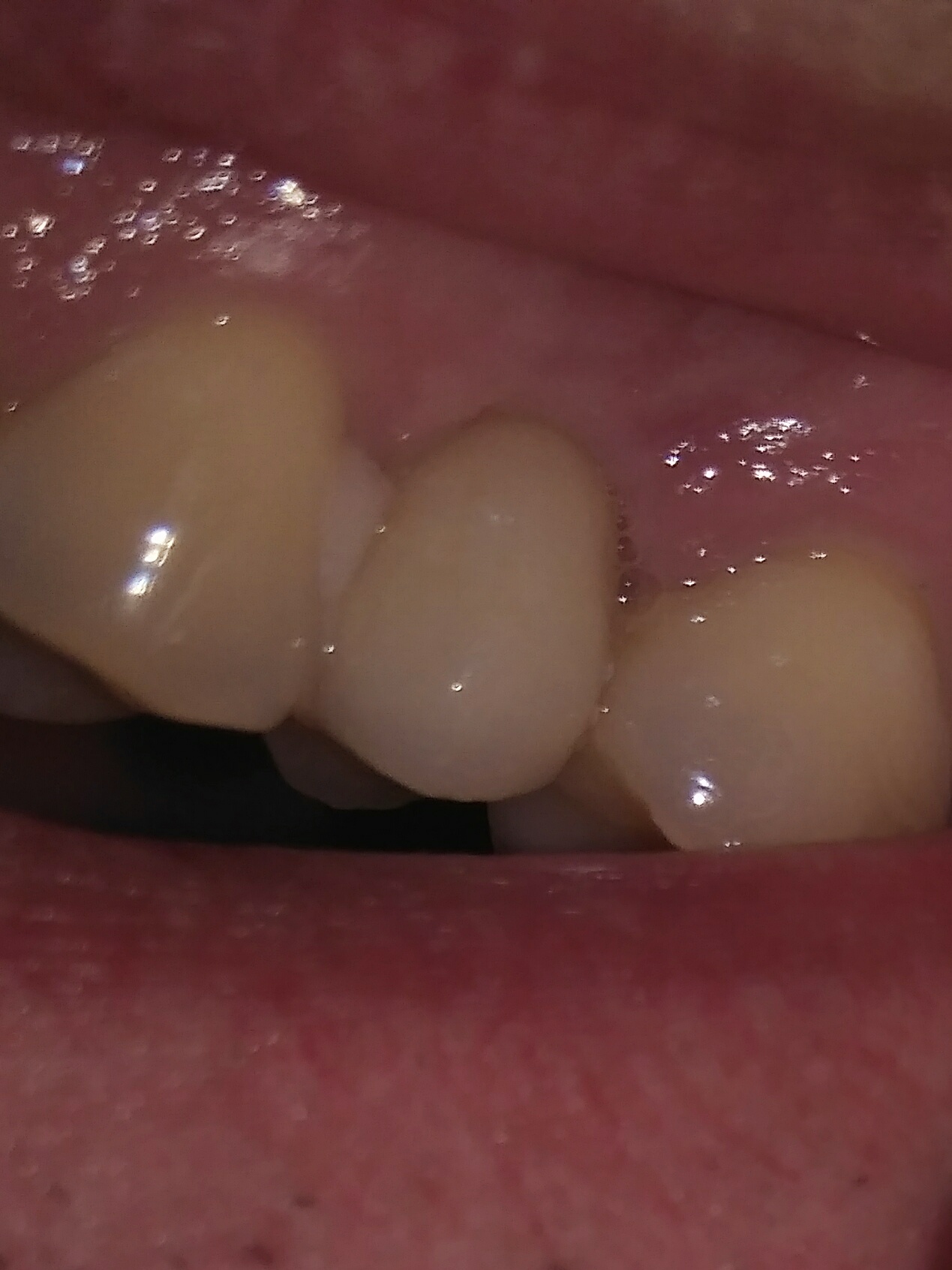 Застревает пища между зубами? Смените стоматолога!