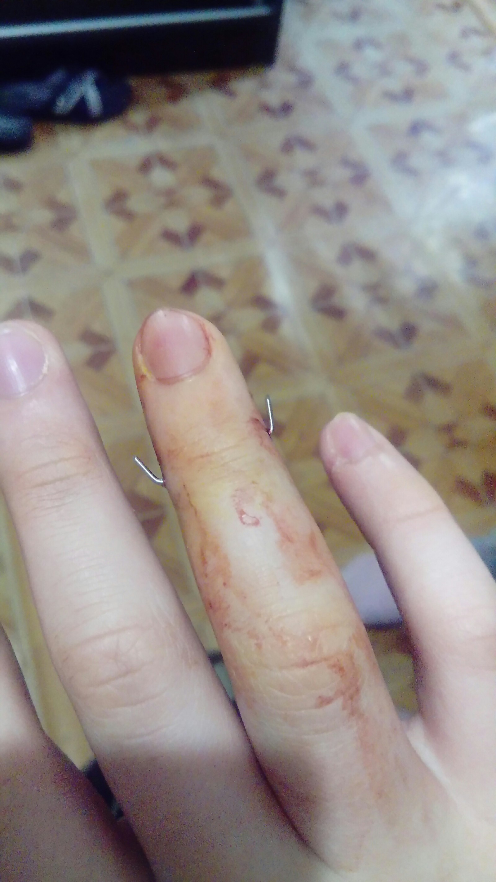 finger surgery - My, Longpost, Right hand, Fracture, Doctors, Operation