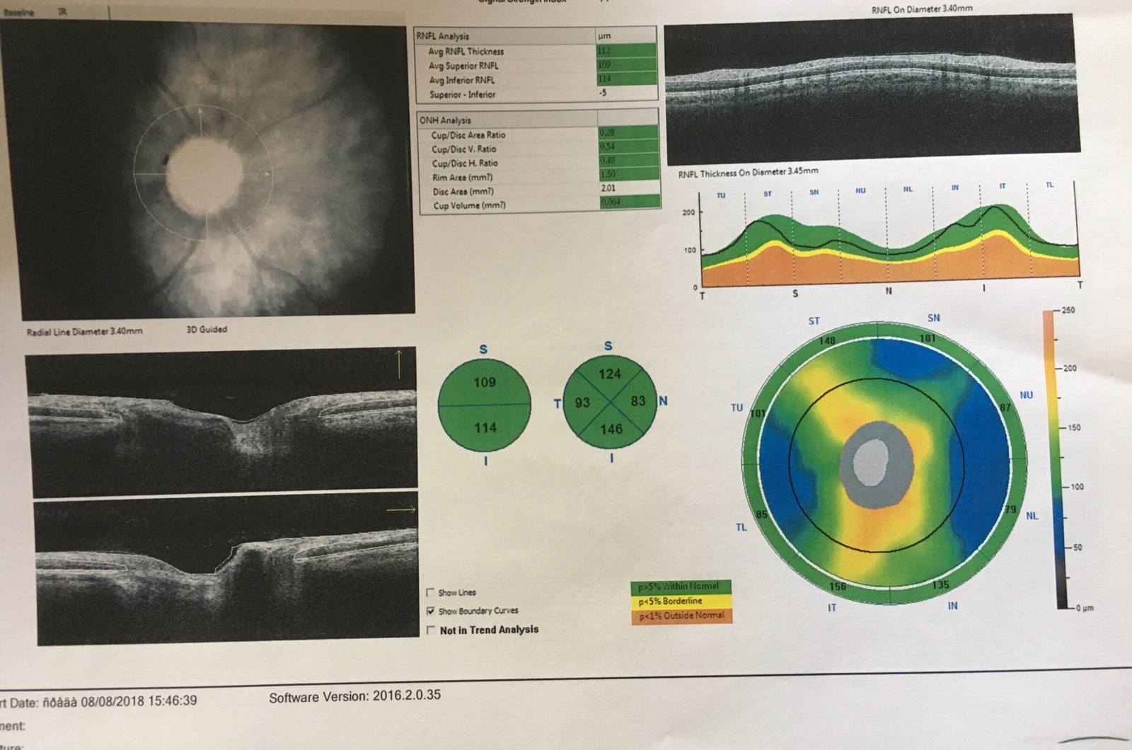 Ophthalmologists, surgeons (diabetologists) - need your opinion, please - My, Eyes, Surgery, Diabetes, Help, Operation, Longpost