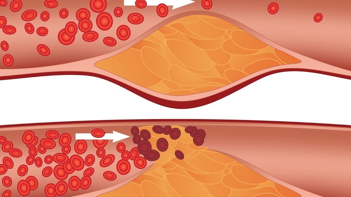 Cause of death #1 - My, Atherosclerosis, Plaque, Longpost, Video