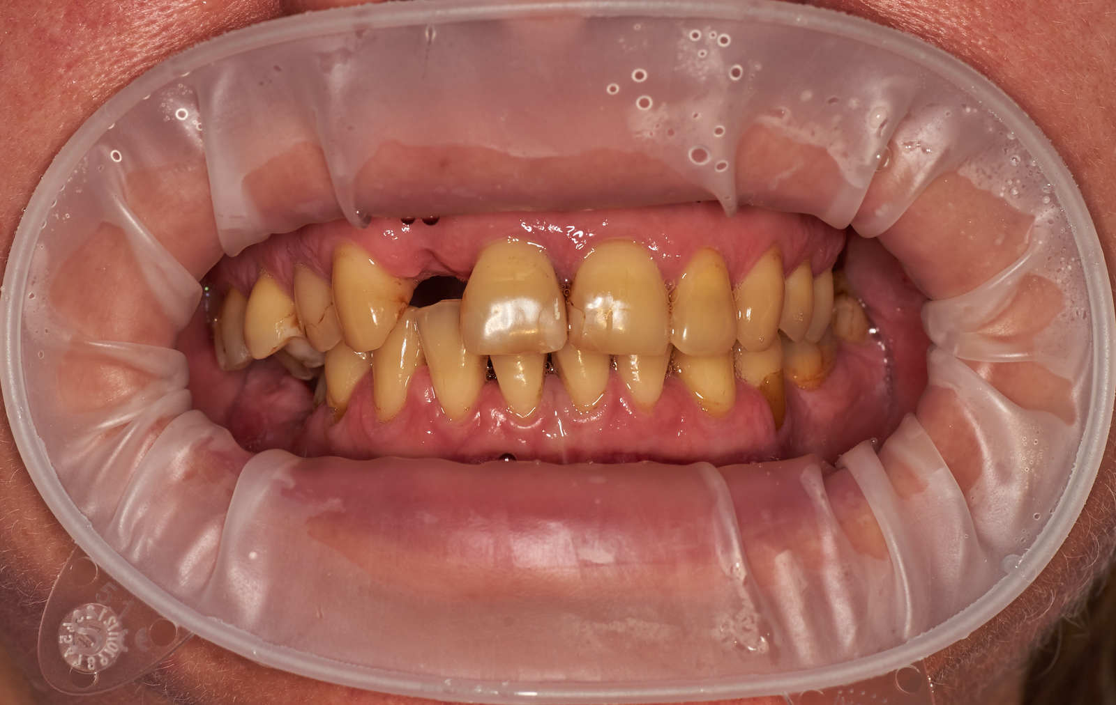 A little makeover - My, Teeth, cermet, Dentistry, Crowns, Work, Longpost